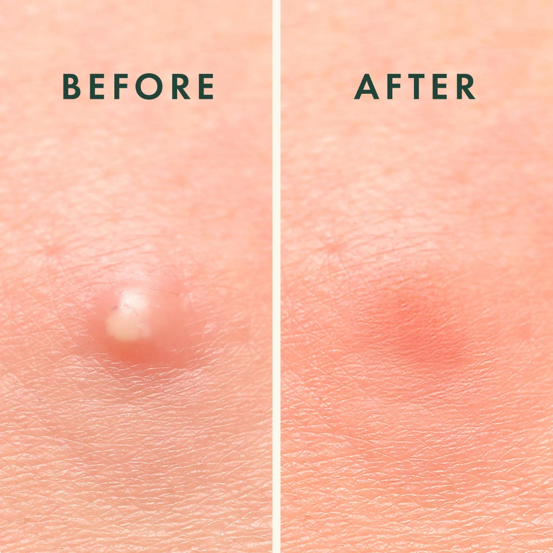 Acne Pimple Master Patch