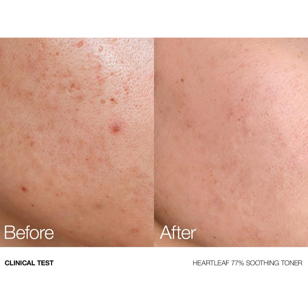 Heartleaf 77% Soothing Toner